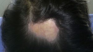 Morfea circunscrita en cuero cabelludo. Alopecia secundaria.