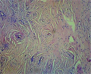 Fibrosis concéntrica densa y células inflamatorias mixtas (aumento a 20 X; tinción con hematoxilina y eosina).