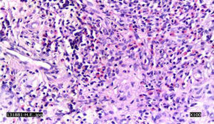 Linfocitos, plasmocitos, numerosos eosinófilos y fibroblastos en proliferación (aumento a 40 X, tinción con hematoxilina y eosina).