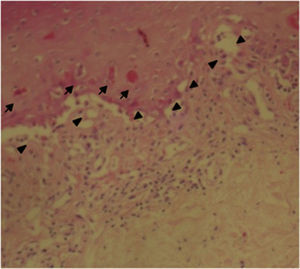 Biopsia de piel: epidermis con extenso daño de interfase vacuolar (triángulos), asociado a disqueratocitos (flechas pequeñas) y vesiculación subepidérmica.