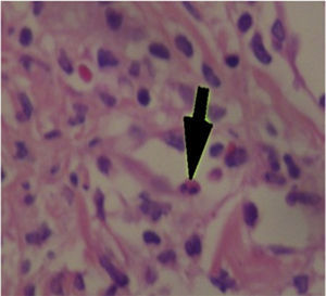 Dermis papilar de aspecto edematoso con infiltrado perivascular linfocitario con algunos eosinófilos (flecha grande).