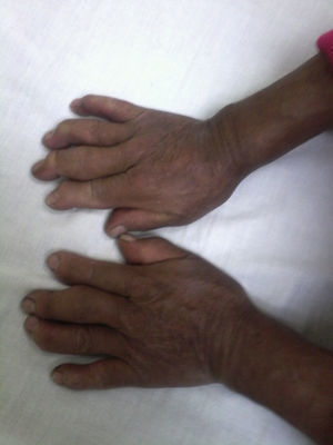 Tumefacción de articulaciones metacarpofalángicas e interfalángicas proximales, desviación cubital de los dedos, deformidad en flexión de interfalángicas distales. Fuente: autores.