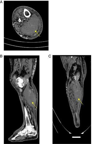 Computed tomography imaging of (A) axial, (B) sagittal and (C) coronal planes of right calf that demonstrate a heterogenous collection of fluid of 17cm×9.4cm×7cm in the thickness of the medial gastrocnemius muscle (arrow), with significant soft tissue edema.