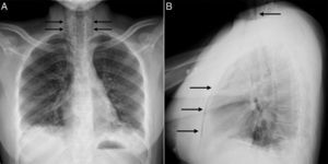 Radiografía de tórax en la que se observan signos de neumomediastino que se extiende hasta la región tiroidea (flechas), sin neumotórax ni enfisema subcutáneo asociados, y opacidades parenquimatosas bibasales A) y B).