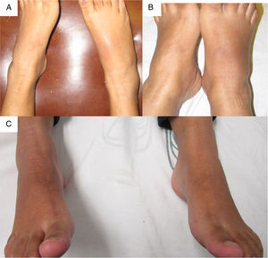 A y B) Vista AP del pie derecho en la cual se aprecia un aumento de volumen en el tarso y el tobillo, eritema en tarso derecho. C) Vista AP posterior a la infiltración de dexametasona intraarticular.