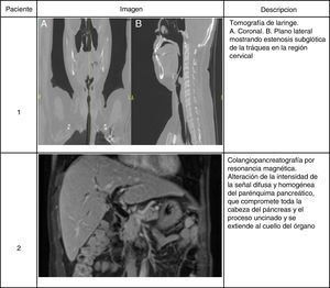 Hallazgos imagenológicos en 2 pacientes con enfermedad relacionada con IgG4. Paciente 1. Tomografía de laringe. A) Plano coronal. B) Plano lateral que muestra estenosis subglótica de la tráquea en la región cervical. Paciente 2. Colangiopancreatografía por resonancia magnética. Alteración de la intensidad de la señal difusa y homogénea del parénquima pancreático que compromete toda la cabeza del páncreas y el proceso uncinado y se extiende al cuello del órgano.