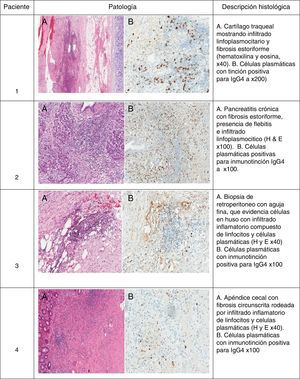 Hallazgos patológicos en 4 pacientes con enfermedad relacionada con IgG4. Paciente 1. A) Cartílago traqueal que muestra infiltrado linfoplasmocitario y fibrosis estoriforme (hematoxilina y eosina, ×40). B) Células plasmáticas con tinción positiva para IgG4, ×200). Paciente 2. A) Pancreatitis crónica con fibrosis estoriforme, presencia de flebitis e infiltrado linfoplasmocítico (hematoxilina y eosina, ×100). B) Células plasmáticas positivas para inmunotinción de IgG4 (×100). Paciente 3. A) Biopsia de retroperitoneo con aguja fina, que evidencia células en huso con infiltrado inflamatorio compuesto de linfocitos y células plasmáticas (hematoxilina y eosina, ×40). B) Células plasmáticas con inmunotinción positiva para IgG4 (×100). Paciente 4. A) Apéndice cecal con fibrosis circunscrita rodeada por infiltrado inflamatorio de linfocitos y células plasmáticas (hematoxilina y eosina, ×40). B) Células plasmáticas con inmunotinción positiva para IgG4 (×100).