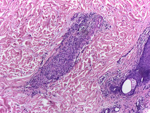 Se observa gran proceso inflamatorio de localización septal en tejido celular subcutáneo, caracterizado por acúmulo de linfocitos, plasmocitos y células gigantes multinucleadas, además de escasos polimorfonucleares neutrófilos.
