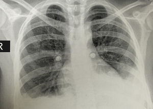 Radiografía de tórax: proyección posteroanterior que evidencia derrames pleurales bilaterales y una imagen sugestiva de consolidación basal izquierda.