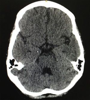 Tomografía cerebral simple, con ligeros cambios de microangiopatía y sin evidencia de lesiones ocupantes de espacio.