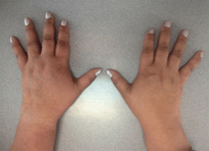 Foto de las manos del paciente en las que se evidencia sinovitis de interfalángicas proximales, metacarpofalángicas y muñecas.