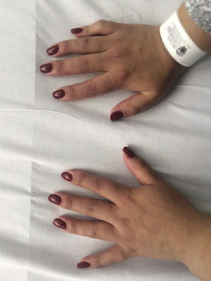 Foto de las manos del paciente en las que se evidencia sinovitis de interfalángicas proximales, metacrapofalángicas y muñeca izquierda.
