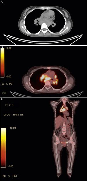 (1A a 1C). Panel A muestra ganglios hipermetabólicos en mediastino superior en FDG PET/CT. En el CT scan las adenomegalias son marcadas con diámetros entre 7.7x6mm. Panel B imagen axial (coronal Panel C) con áreas de intensa captación de FDG en nódulos linfáticos mediastinales con SUV de 17, paratraqueales superior derecha e izquierda y en regiones hiliares pulmonares bilaterales.
