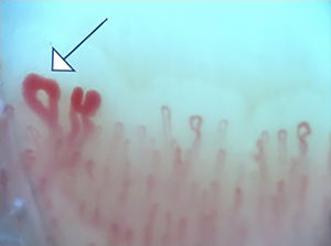 Patrón temprano de esclerosis sistémica: presencia de megacapilar (capilar con diámetro mayor de 50um −flecha−) (capilaroscopio Optilia, aumento ×200).