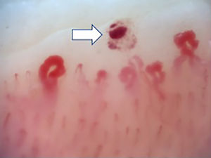 Presencia de patrón activo de esclerosis sistémica: mayor número de megacapilares y de hemorragias −flecha− (capilaroscopio Optilia, aumento ×200).