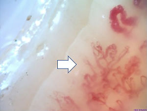 Presencia de patrón tardío de esclerosis sistémica (presencia de neovascularización y zonas avasculares −flecha−) (capilaroscopio Optilia, aumento ×200).