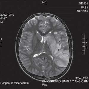 RMN en fase T2, con lesión hiperintensa que compromete polo anterior temporal izquierdo, ínsula y labio temporal del opérculo ipsolateral.