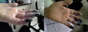 Lesiones isquémicas de las falanges distales del tercer, cuarto y quinto dedos de la mano izquierda.