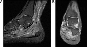 Imágenes de resonancia magnética del cuello de pie izquierdo. A) Sagital PD con saturación grasa. B) Coronal PD con saturación grasa. Muestran marcado edema difuso de las fibras musculares de los músculos plantares y del compartimento posteromedial del tobillo.