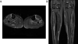 Imágenes de RM del cuello de piernas comparativas. A) Axial PD con saturación grasa. B) Coronal PD con saturación grasa. Muestran edema de los músculos en el compartimento posterior de la pantorrilla derecha y de los músculos en el compartimento anterior de la pantorrilla izquierda. Se debe destacar el importante grado de edema y cambios de fascitis.