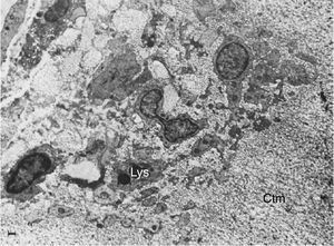 Microscopia electrónica que muestra fibroblastos con lisosomas (Lys) inmersos y extensiones citoplasmáticas múltiples invadiendo la matriz del cartílago (Ctm)10.