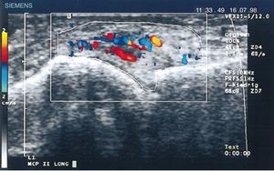 Ecografía longitudinal de articulación metacarpofalángica donde se muestran las primeras imágenes de Doppler con aumento de la vascularización del pannus en un paciente con AR70.