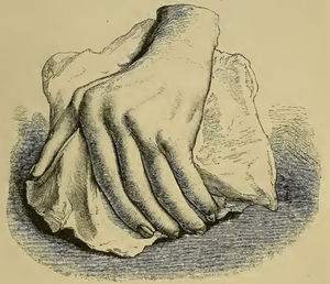 Ilustración del libro de Garrod que muestra una mano deformada con desviación cubital causada por la artritis reumatoide1,2.