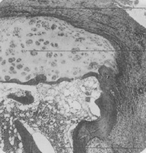 Fotografía de microscopia de luz de la falange distal de un paciente que padecía de la enfermedad denominada, en esa época, como artritis proliferativa tipo extremo. Muestra la formación de tejido grueso de granulación que invade y destruye el cartílago articular5,6.