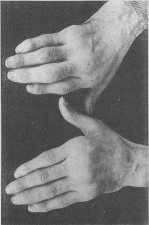 Fotografía de las manos de un paciente de 35 años con antecedente de uretritis gonocócica, que desarrolló años más tarde y de forma progresiva poliartritis de pequeñas y grandes articulaciones. Clasificado como artritis proliferativa5,6.