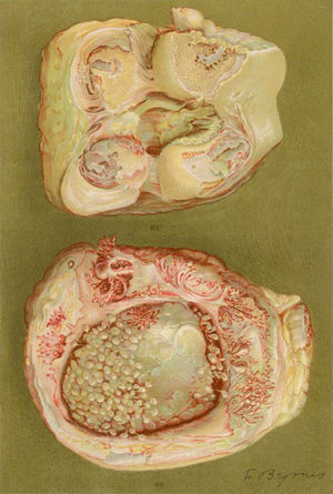 Dibujo de la autopsia de una mujer de 40 años con clínica de poliartritis de grandes y pequeñas articulaciones que produjeron gran discapacidad y anquilosis. Se evidencia la pérdida del cartílago articular y de zonas de formación ósea que causan la anquilosis de la rodilla5,6.