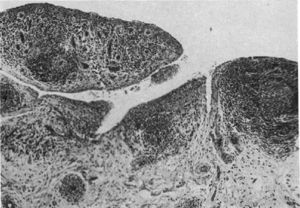 Histología con microscopía de luz. Clásica sinovitis de rodilla en AR que muestra hipertrofia vellosa, infiltración vascular y nódulos linfoides con un centro germinal en el extremo derecho9.