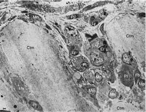 Imágenes por microscopía electrónica del pannus. Se muestra la invasión de un vaso (En: endotelio; Er: eritrocito) en la unión del pannus y el cartílago (Ctm) por linfocitos (Ly), células plasmáticas (Pl), monocitos (Mn), macrófagos (Mp) y fribroblastos (Fb)10.