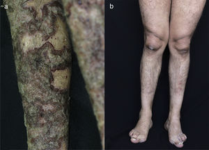 a) En extremidades inferiores presenta placas eritematosas circunscritas con capas de escamas adherentes, pardo oscuro y grisáceas, de bordes eritematosos y elevados con respecto al centro deprimido, b) 10 años después se evidencia ausencia de lesiones cutáneas.
