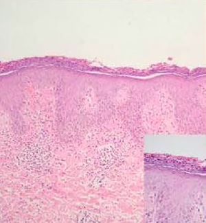 Biopsia de piel con aumento 4X: epidermis acantósica con patrón psoriasiforme. Aumento 40X: estrato córneo con hiperqueratosis con paraqueratosis, microabscesos de Munro, disminución de estrato granuloso y neovascularización en dermis papilar.
