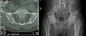 a) Tomografía computarizada de articulaciones sacroilíacas, corte axial: fusión de las articulaciones sacroilíacas en los 2/3 inferiores por anquilosis bilateral y esclerosis de 1/3 superior bilateral. b) Radiografía de cadera, proyección anteroposterior: fusión completa de las articulaciones sacroilíacas, las relaciones articulares coxofemorales y en la sínfisis del pubis están preservadas, densidad ósea disminuida.