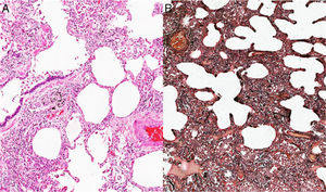 Biopsia de una cuña pulmonar. A)Tinción de H & E. B)Pentacrómico de Russell-Movat. Se observa un patrón histológico de neumonía intersticial inespecífica de predominio subtipo celular.