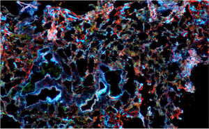 Microscopía confocal de tejido pulmonar con inmunofluorescencia para actina (roja), citoqueratina (verde) y núcleo (azul). Potencia de 2,5×. Se observa expansión del intersticio y engrosamiento de los septos alveolares que compromete el parénquima pulmonar de manera difusa y uniforme.