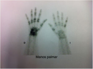 Gammagrafía ósea de manos con hallazgos característicos de artropatía psoriásica2: afección asimétrica, afección de interfalángicas distales y distribución en rayo (quinto dedo de la mano izquierda y tercero y cuarto de la mano derecha).