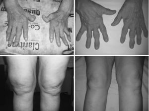Left. Persistent synovitis in hands and knees in a patient with refractory adult onset Still's disease treated with prednisone and methotrexate. Right. Rapid responses after golimumab treatment.