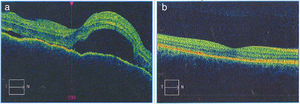 a) La imagen de la OCT macular del OD diagnóstica permite observar el neuroepitelio con superficie irregular, pliegues retinianos en la membrana limitante interna, pérdida de la depresión foveal con aumento generalizado del espesor macular. También se observan múltiples desprendimientos serosos del neuroepitelio con acúmulo de fluido subretinal, imágenes que confirman la enfermedad de Vogt Koyanagi Harada. b) En la OCT macular del OD tomada 6 meses después de iniciado el tratamiento, se aprecia claramente resolución de los desprendimientos retinianos y el complejo EPR-membrana de Bruch-coriocapilares sin alteraciones. La coroides se muestra con patrón y grosor de apariencia normal.