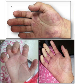 Mano derecha. A) Livedo reticularis. B) Cambios tróficos en pulpejos de dedos. C) Disminución de la perfusión distal a predominio de la arteria cubital.
