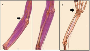 A) AngioTEM del miembro superior derecho que muestra obstrucción en el flujo de las arterias radial y cubital, y leve flujo en arteria interósea. B) Ausencia de flujo en el arco palmar.