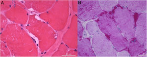 Muscle biopsy showing subsarcolemmal vacuoles containing glycogen (PAS positive material). (A) H&E, (B) PAS, scale bar: 50μm.