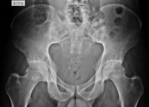 Anteroposterior projection of the pelvis showing changes of enthesopathy and bilateral grade III sacroiliitis, confirming the diagnosis of ankylosing spondylitis.