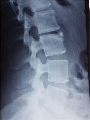 Radiografía lateral de columna lumbar que muestra una imagen triangular en la parte anterosuperior de L3.