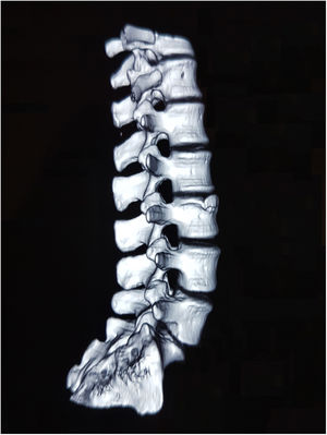 Tomografía axial computada de columna lumbar con reconstrucción 3D que señala una irregularidad ósea anterosuperior en L3 que no se separa de su cuerpo vertebral.