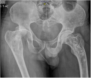 Subluxación de cadera derecha, lesiones osteolíticas y osteoblásticas alternantes asimétricas en pelvis de un paciente con EP poliostótica III.