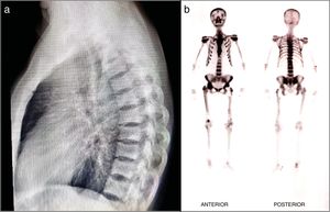 a) Rayos X: lesiones osteoblásticas en columna. b) Gammagrafía: lesiones hipercaptantes de predominio en esqueleto axial, hombros y pelvis de un paciente con EP poliostótica III.