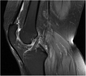 Condrocalcinosis artrósica de rodilla izquierda por RMN.