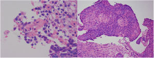 Biopsia de pulmón, fragmento del lóbulo inferior derecho. Se observa compromiso por carcinoma escamocelular queratinizante.